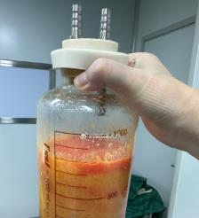 广西水动力吸脂手术要做多久？